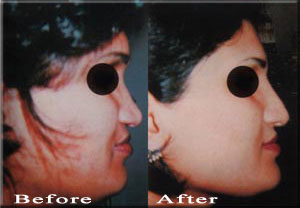 Offer Nasal Implant, Cosmetic Surgery