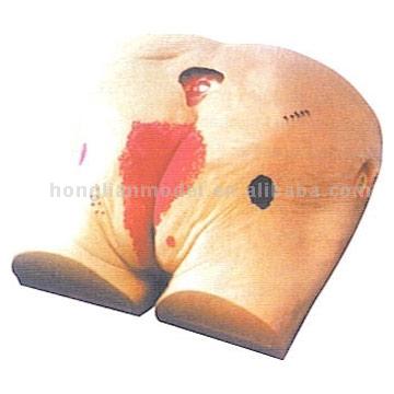  Decubitus Wound Care (Decubitus Wound Care)