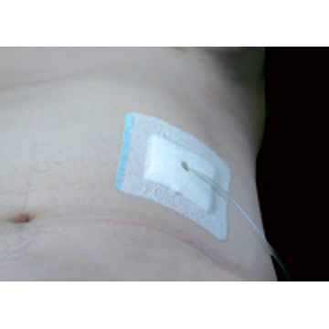 Wound Dressing Paste ( Wound Dressing Paste)