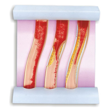  Artery Comparison Model in Normal & Abnormal Status (Artery Vergleich Modell in Normal-und Abnormal Status)